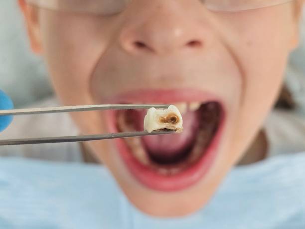 Best Knocked-Out Tooth Emergency  in Hamton, IL