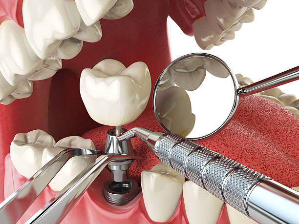 Best Dentist for Tooth Abscess  in Hamton, IL